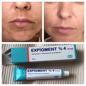 Відбілюючий крем Експігмент Expigment 4%, 30 г